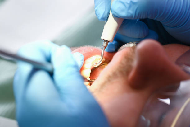 Best Emergency Broken Tooth Repair in Sausalito, CA